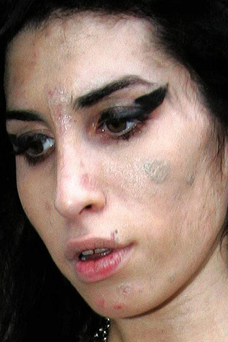 Amy Winehouse are cea mai urata piele din showbizz!