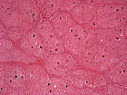 Ministerul Sanatatii a aprobat noile ghiduri terapeutice pentru hepatita B