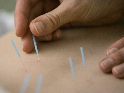 Acupunctura poate elimina efectele secundare ale chimioterapiei