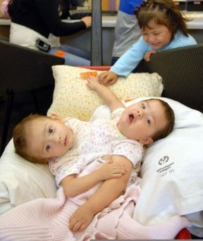 Doi gemeni siamezi impart o singura pereche de picioare