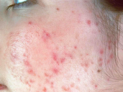 Sapunurile antibacteriene, interzise celor care sufera de acnee