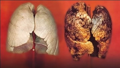 S-a inventat dispozitivul care poate "mirosi" cancerul de plamani. Cum arata nasul virtual care depisteaza boala