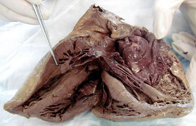 Ultima saptamana din an: cele mai multe morti din cauza bolilor de inima