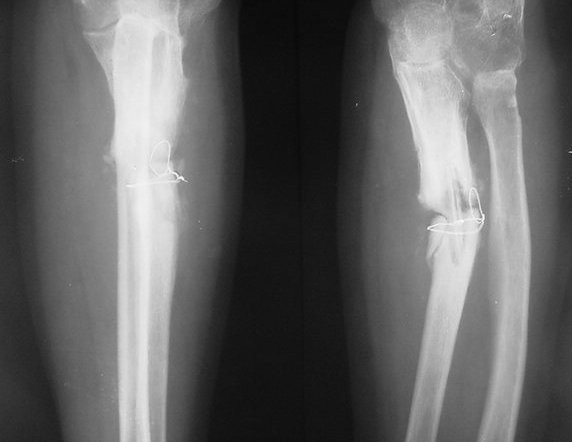 Oase rupte, lipite în trei minute, cu un adeziv-minune inventat de cercetătorii chinezi. Revoluție în medicină