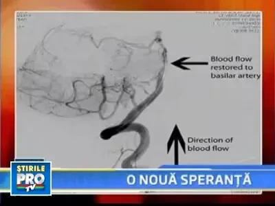 Cheagurile de sange, inlaturate fara operatie!