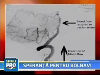 Cheagurile de sange, inlaturate fara operatie!