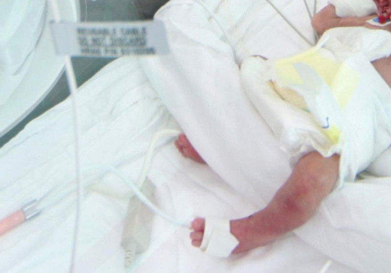 Plangere penala impotriva medicilor in cazul copilului cu fractura de femur