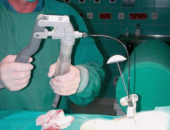 Vertebroplastie, operatie realizata in premiera in Romania