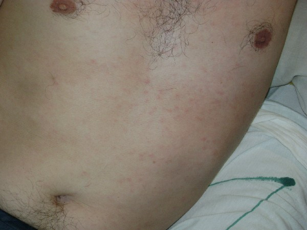 La Spitalul de Psihiatrie din Turceni, sifilisul e in floare!