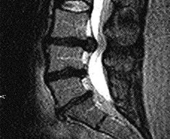 CSID: Totul despre hernia de disc