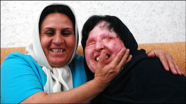 Ai putea sa faci la fel? Decizia surprinzatoare a femeii din Iran care a fost orbita cu acid