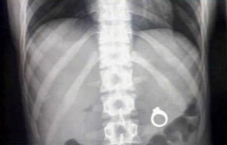 A inghitit inelul de logodna dupa ce iubitul il ascunsese in milkshake