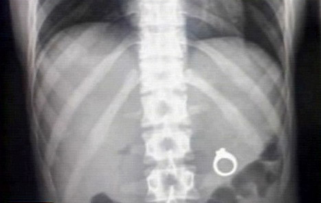 Chei, ace si inele. Asta au inghitit copiii care au ajuns la urgenta