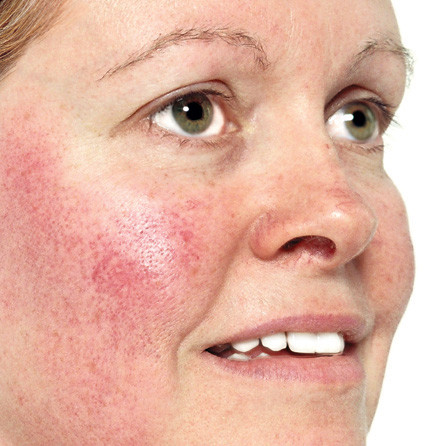 Pericolul de rozacee se instaleaza dupa 30 de ani!