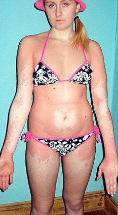 Solarul a condus-o la chimioterapie!