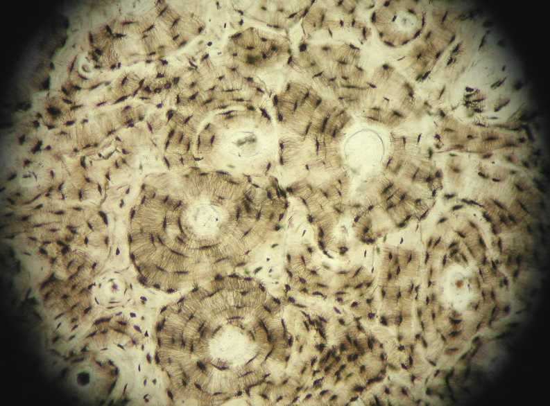 CSID: Depunerile anormale de calciu pe oase, un fenomen ingrijorator