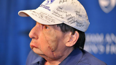 A primit o noua sansa la viata! Al doilea transplant de fata din SUA