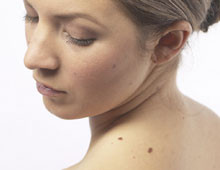 Românii asociază în mod greșit cancerul de piele cu alunițele. Împreună, putem SKINba lumea în bine