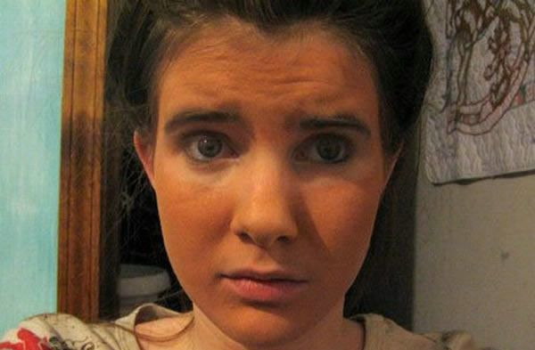 Prajiti la soare ca puiul la rotisor! Vezi aici cum sa NU te bronzezi!