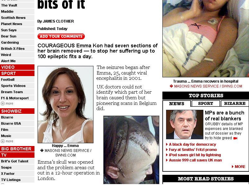 Mi-au taiat sapte portiuni din creier!