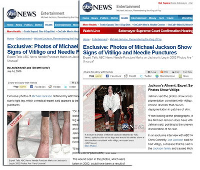 Picioarele lui Michael Jackson, distruse de vitiligo si perfuzii! VEZI FOTO