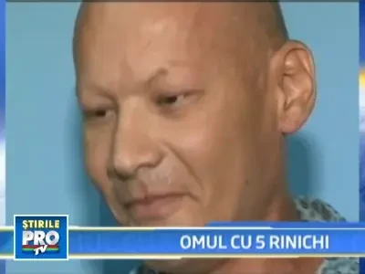 Primul roman care traieste cu cinci rinichi in organism!