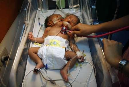 A nascut gemene care impart acelasi trup!