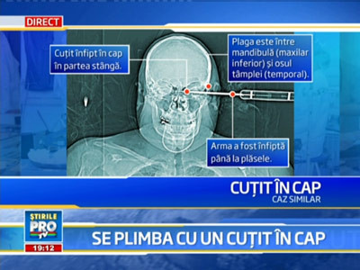 La pas prin Bucuresti cu un cutit infipt in cap!