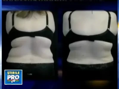 Caldura ajuta la recuperarea pacientilor ce au trecut printr-o liposuctie