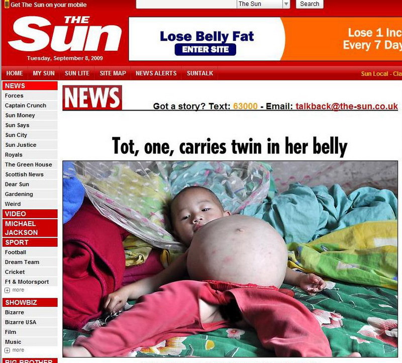 INCREDIBIL! La un an isi poarta in pantece fratele geaman!