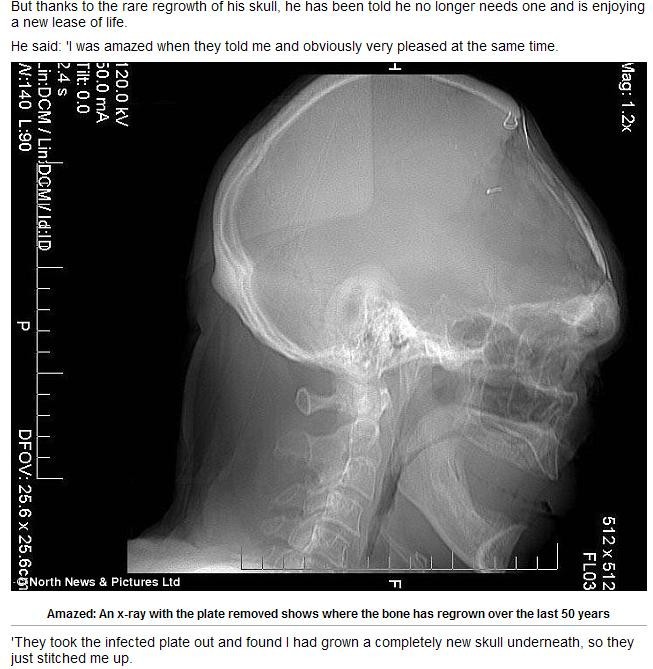 I-a crescut osul la loc, dupa ce a pierdut o parte din craniu in accident!