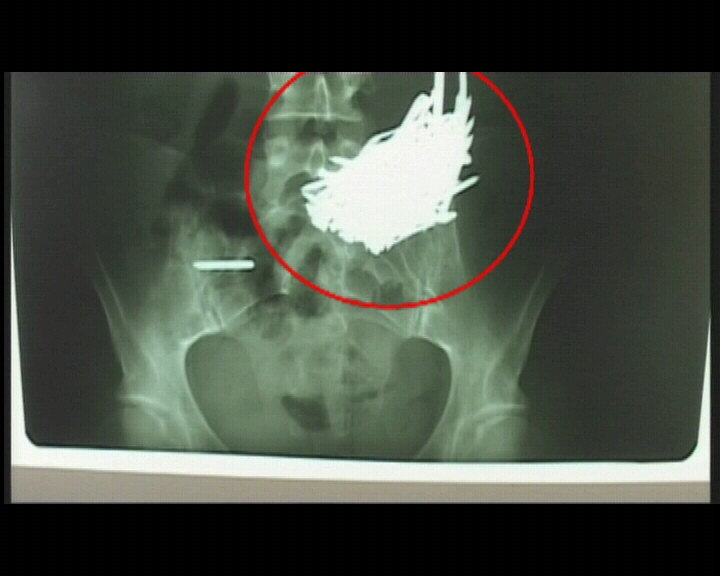 Femeia care a inghitit 100 de cuie a fost operata