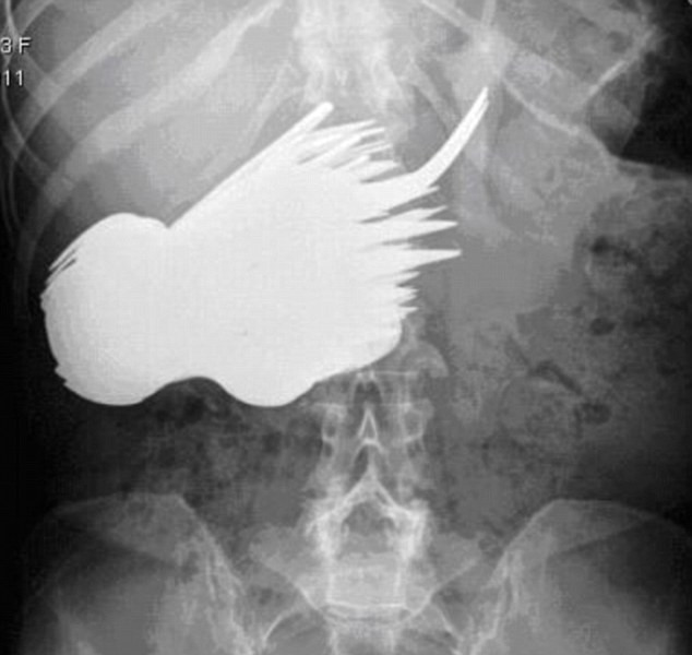 SOC la radiografie! A inghitit 78 de linguri si furculite!