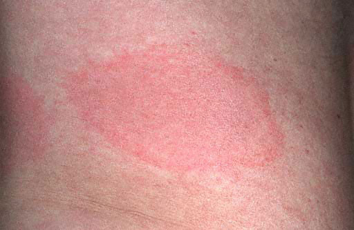 Atentie la capuse! Transmit o boala cu simptome ca ale gripei de sezon