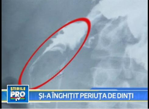 A inghitit o periuta de dinti de 17 centimetri, care a ajuns in stomac!