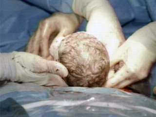 Operata in timp ce era inca, partial, in pantecele mamei