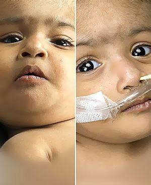 Siamezele din Bangladesh, unite in zona capului, au fost separate cu succes