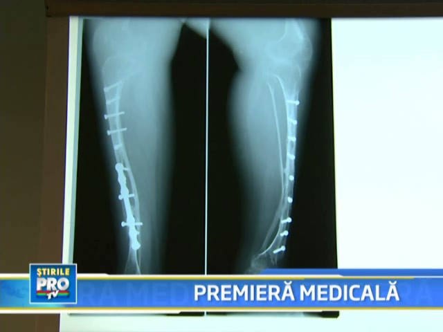 Premiera! Medicii au reconstruit o tibie, din alte oase si celule stem