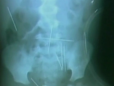 Socant: 50 de ace, unele lungi si de 5 cm, infipte in corpul unui copil!