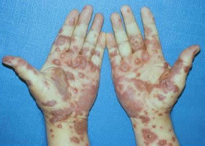 Atentie la ce medicamente luati! Puteti suferi reactii alergice grave!