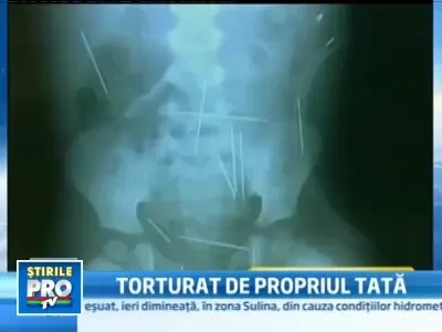 Socant: 50 de ace, unele lungi si de 5 cm, infipte in corpul unui copil!