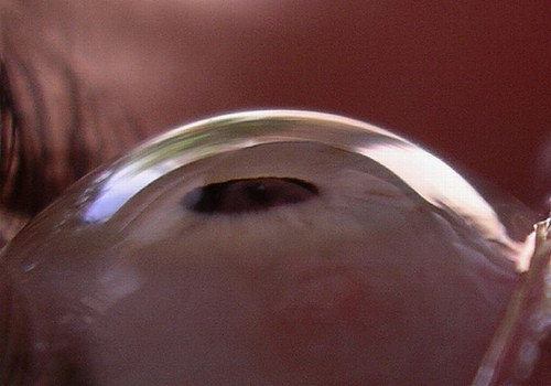 S-a realizat primul transplant de cornee artificiala in Romania!