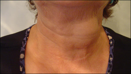 Pastilele pentru tiroida, greu de gasit in farmacii. Stocurile mici ingrijoreaza bolnavii