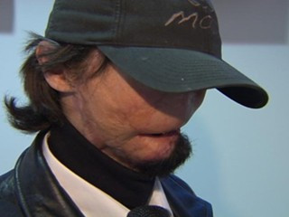 Omul fara chip a facut transplant integral de fata. Vezi cum arata acum