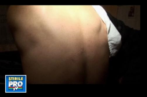 INCREDIBIL! Traieste de 7 ani cu lama unui cutit infipta in spate