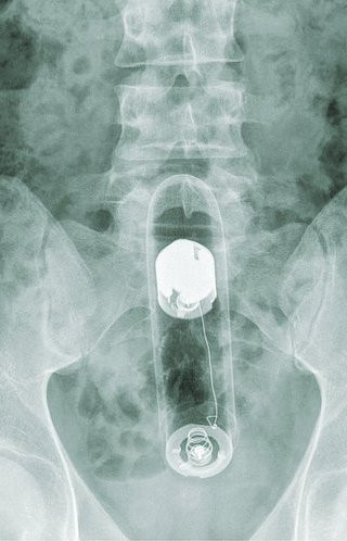 DUREROS! Olandezul "zburator" a ramas cu vibratorul infipt in anus!