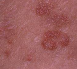 Alarmant!3%dintre romani sufera de psoriazis.CNAS vrea un Registru National