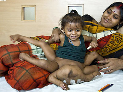 CAZ SOCANT! Copil cu PATRU maini si PATRU picioare, venerat in India!