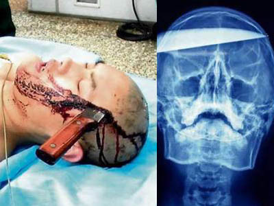 A ajuns, pe picioarele lui, la spital cu un cutit de 25 cm infipt in cap!