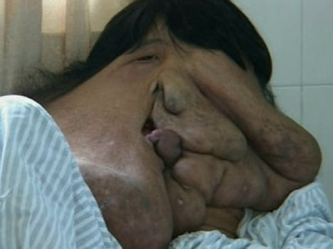 "Omul-elefant"! Desfigurat de o tumoare de 23 de kilograme